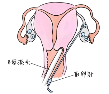 小儿退烧推拿手法 5种常州捐卵宝宝退烧按摩方法